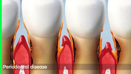 Periodontal Treatments and Procedures