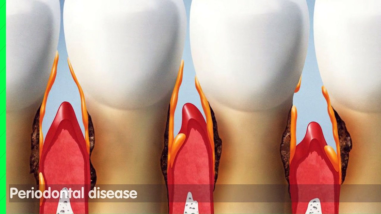 Periodontal Treatments and Procedures