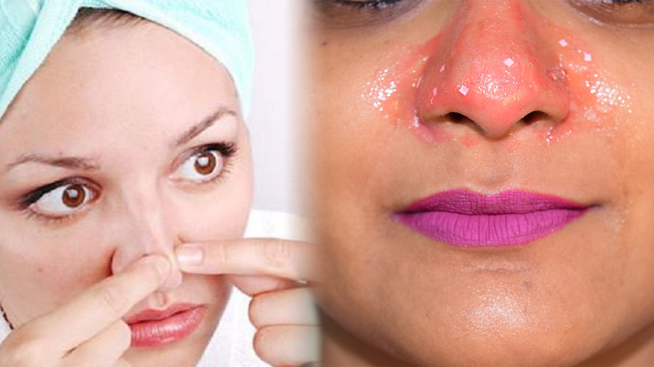 Blackheads: Homemade Face Pack । जिद्दी से जिद्दी Blackheads दूर करेगा ये सस्ता उपाय | Boldsky