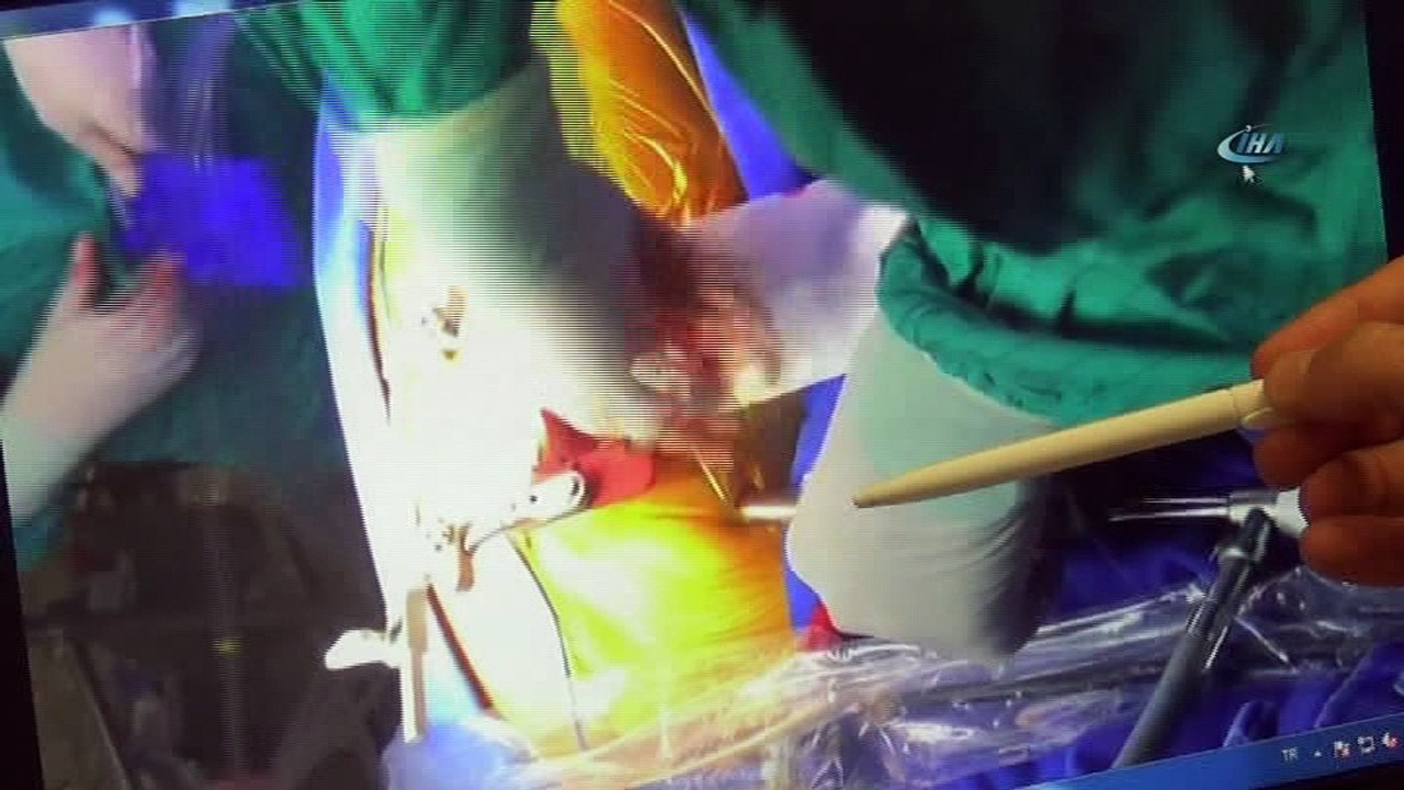 Göğüs kafesi açılmadan delik kalbi ameliyat edildi