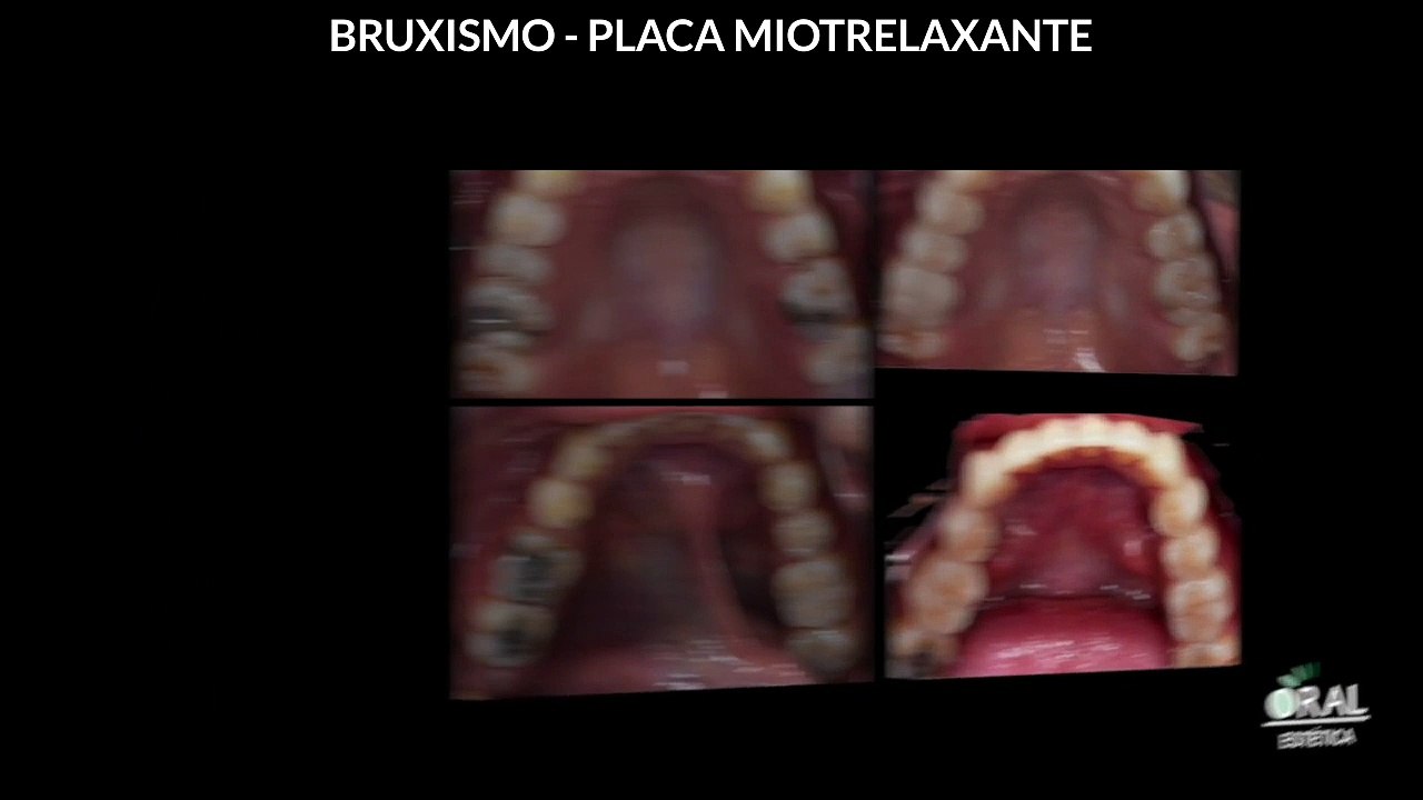 Bruxismo