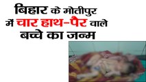 Four hands-legged child born in Motipur Bihar II  बिहार के मोतीपुर में चार हाथ-पैर वाले बच्चे का जन्म