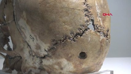 Konya On Bin Yıl Önce İlk Beyin Ameliyatı Yapılan Kafatası İlgi Görüyor Hd