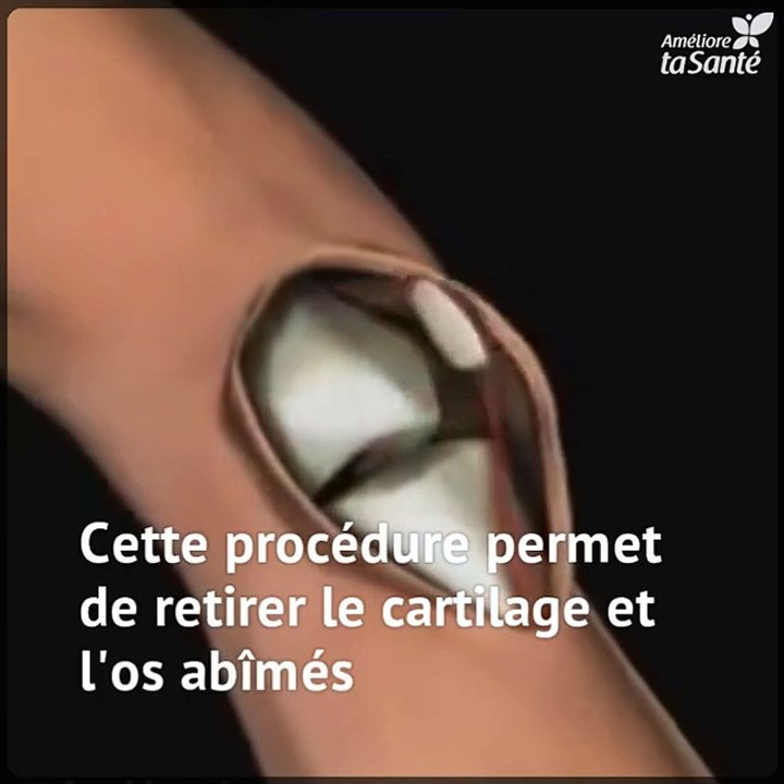 Le remplacement complet de l'articulation du genou se réalise de cette manière.