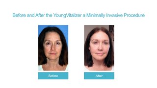 Philip Young MD | YoungVitalizer - The Unique Benefits to Your Skin
