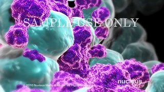 Breast Cancer | Staging | Nucleus Health