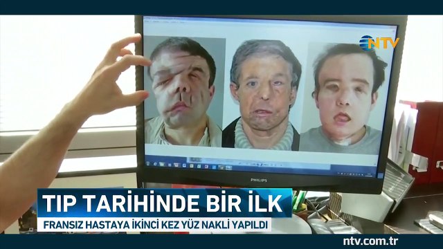 Tıp tarihinde bir ilk... (Fransız hastaya ikinci kez yüz nakli yapıldı)