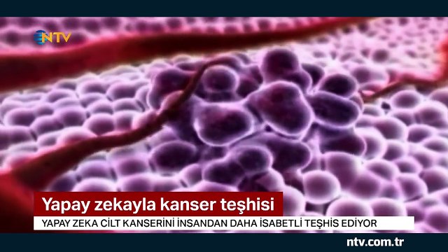 Yapay zeka cilt kanserini insandan daha isabetli teşhis etti