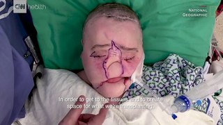 Historic face transplant gives suicide survivor a 'second chance'