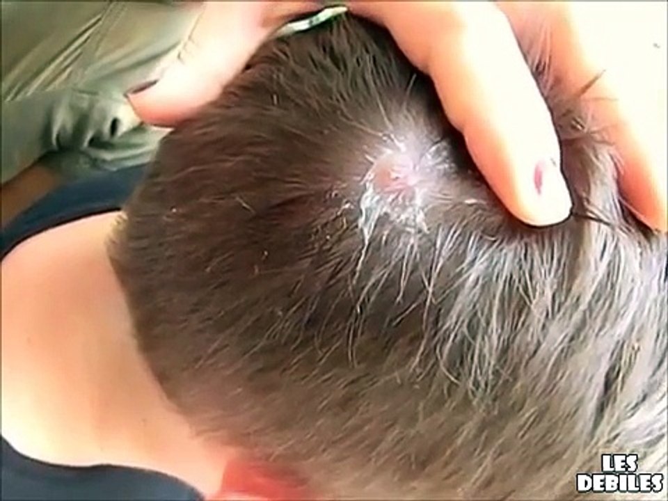 elle enlève une larve énorme du cuir chevelu d'un ami