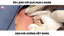 Ớn lạnh với quả mụn u nang nặn mãi không hết nhân