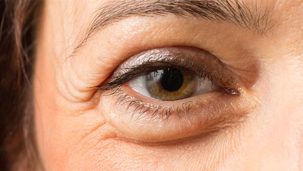 Home Remedies to treat Cholesterol around Eyes: ऐसे हटाएं आंखों के नीचे जमा कॉलेस्‍ट्रॉल | Boldsky