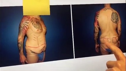 Weight Loss Surgery for Men Including Body Banking Triceps and Shoulders