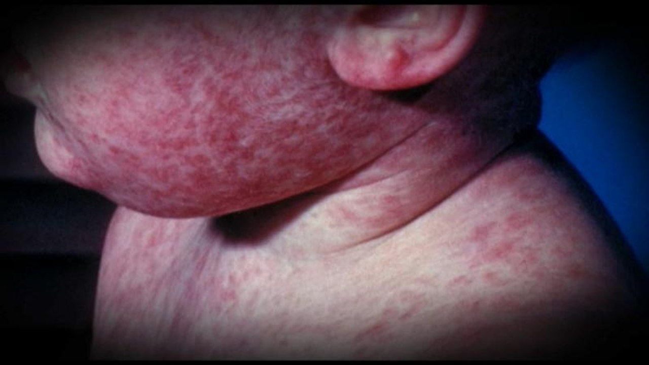 Número recorde de casos de sarampo na Europa