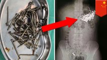 Chinese man swallows 87 nails, 7 push pins after lovers' tiff