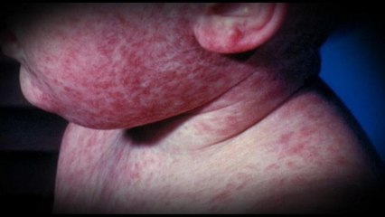 Epidémie de rougeole : l'OMS veut vacciner l'Europe