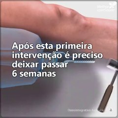 Veja como é realizada a implantação de uma prótese na perna.