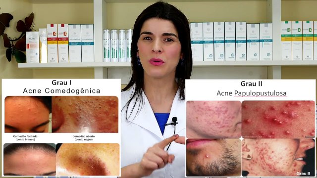 ELIMINE A ACNE (espinhas) Sem Roacutan