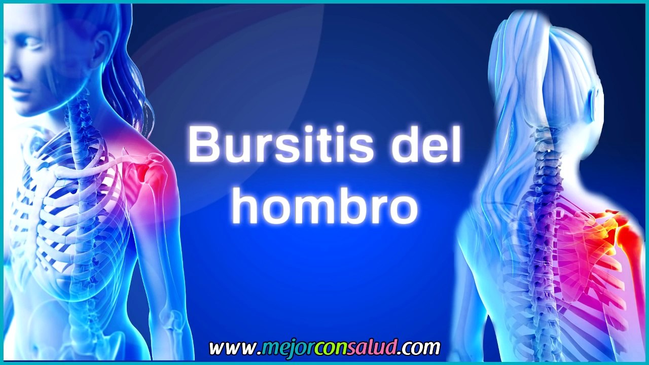 La bursitis de hombro - Qué es, síntomas y tratamiento