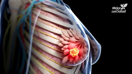 Cáncer de mama - Síntomas y señales de alerta