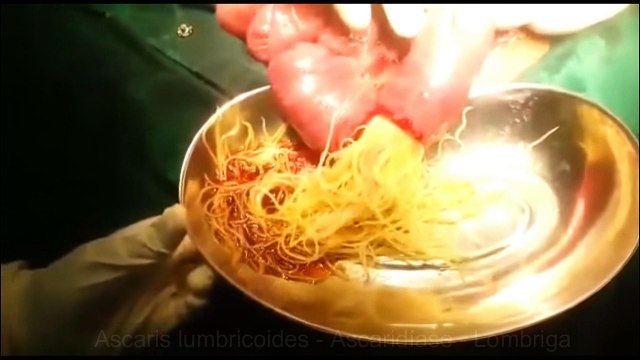 Ascaridíase - Saiba tudo sobre - LOMBRIGA NO INTESTINO (CIRURGIA)
