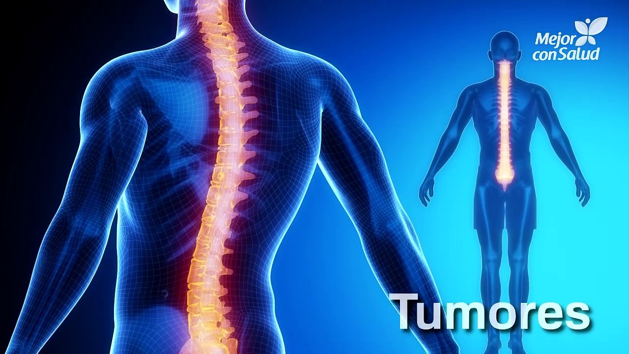 La ciática - Síntomas y tratamiento.