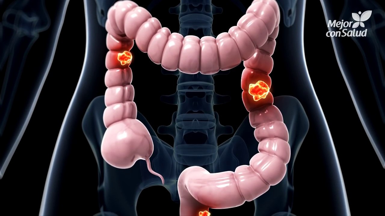 Cáncer de colon