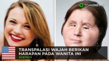 Wanita dapat transpalasi wajah, menjalani hidup baru - TomoNews