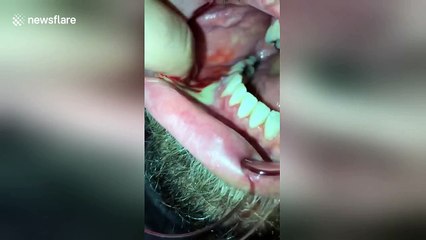 Abscess floods man's mouth with yellow pus