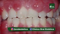 Oral Estética - Hiperplasia Gengival