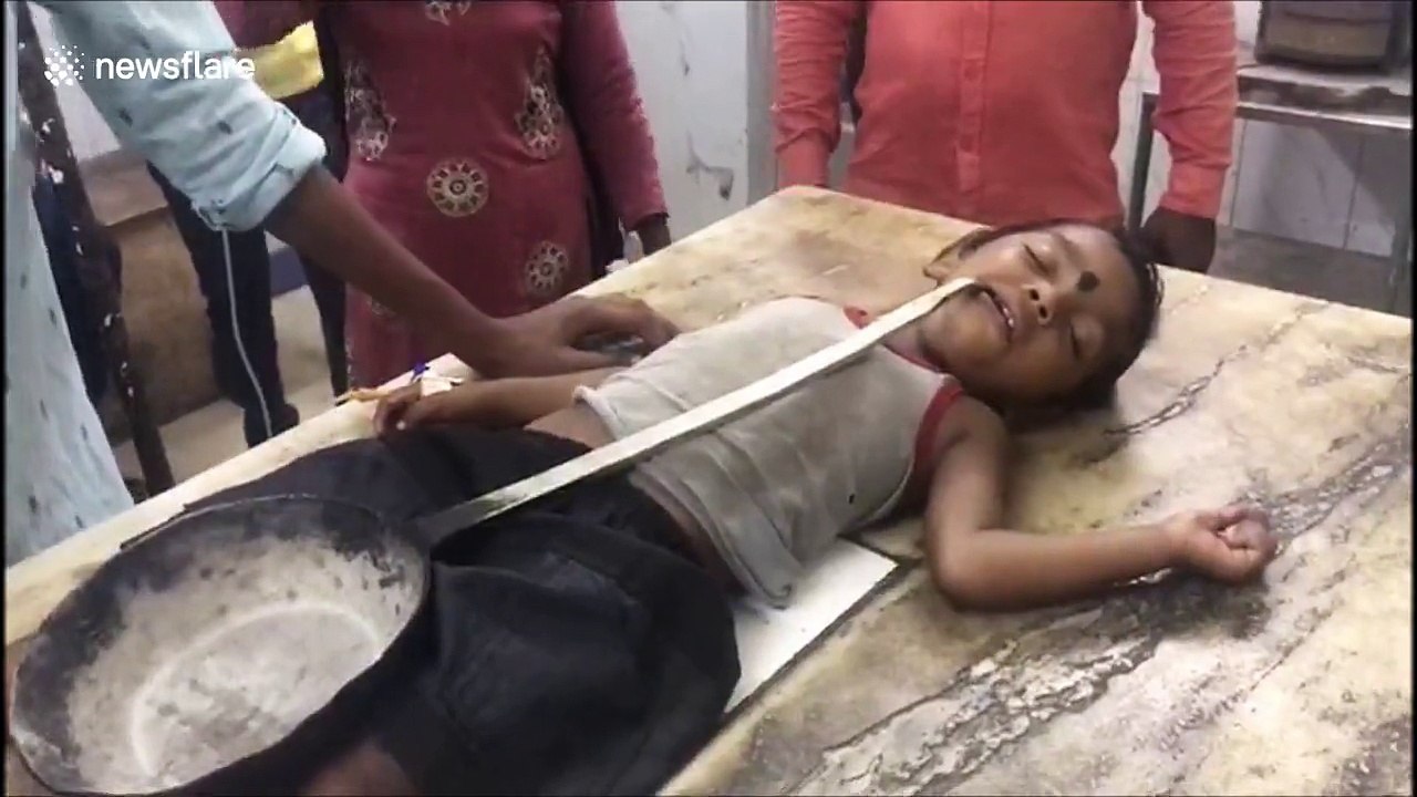 Three foot-long ladle removed from boy's throat in India