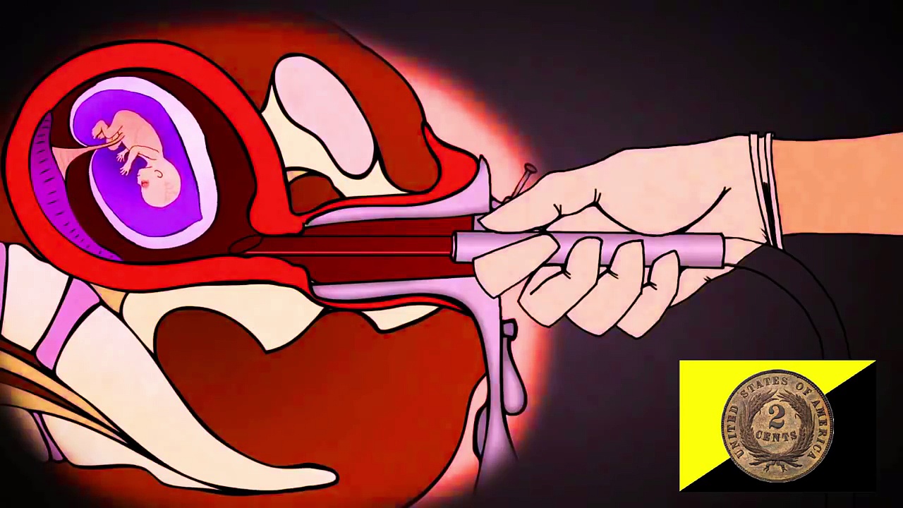 Abortion and Libertarianism: Bodily Autonomy and Self-Defense?