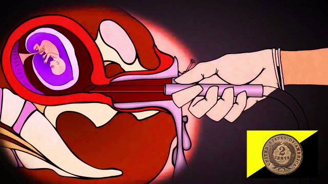 Abortion and Libertarianism: Bodily Autonomy and Self-Defense?