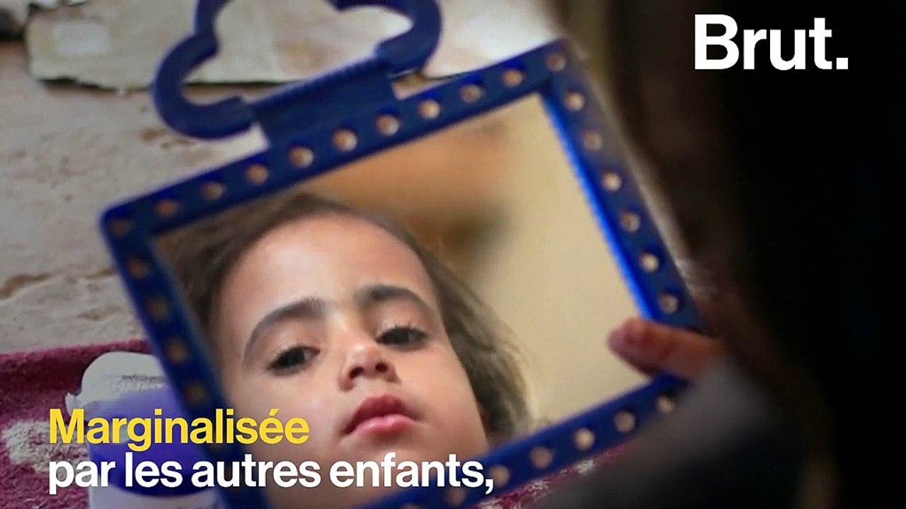 À 4 ans, Haroua souffre d'une rare maladie de peau qui couvre une partie de son corps de poils