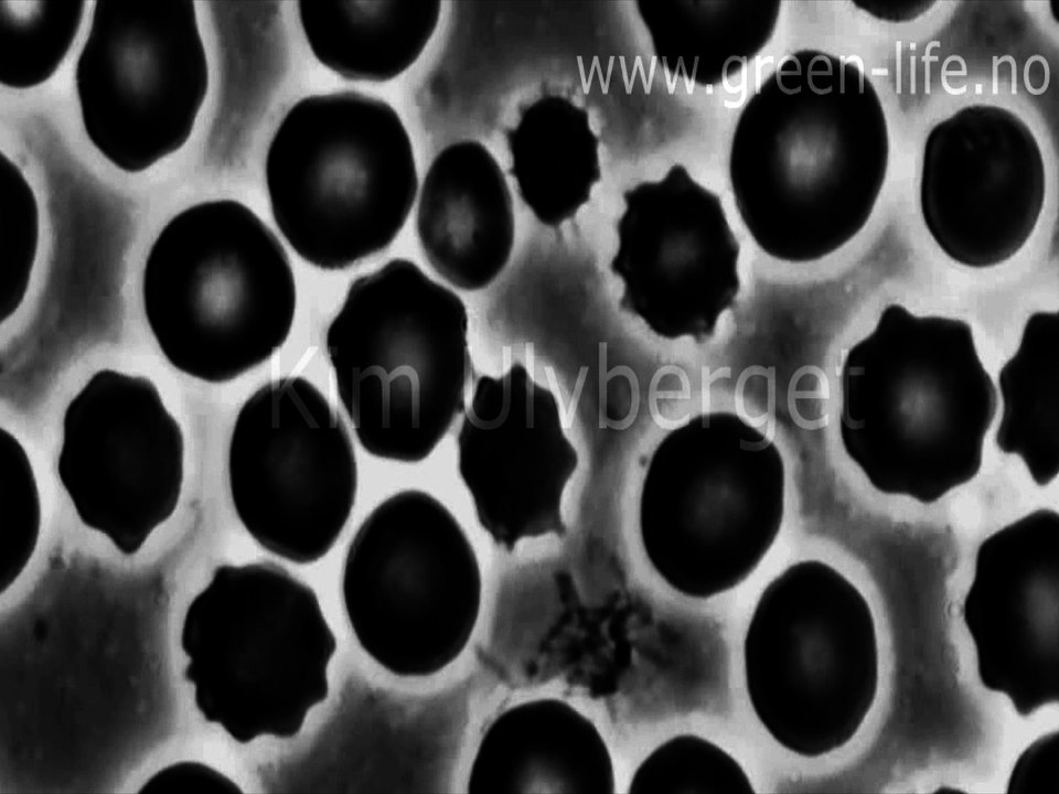 A type of Spirochete Bacteria Colony in Blood. Nutritional Microscopy