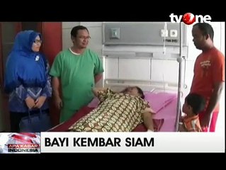 Bayi Kembar Siam Dempet Kepala Lahir di RS H. Sahudin Aceh