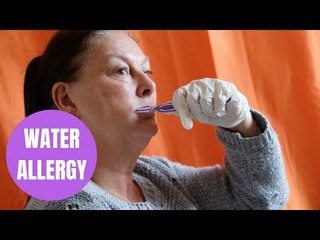 Woman with water allergy so rare the smallest drop of liquid causes her skin to break
