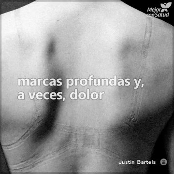 Marcas en la piel, ¿para estar más bellas?