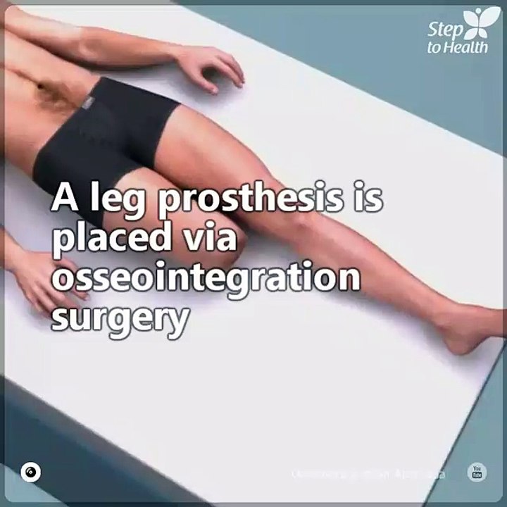Learn how a prosthetic leg is implanted