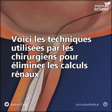 Nous vous expliquons les trois techniques des chirurgiens pour éliminer les calculs rénaux