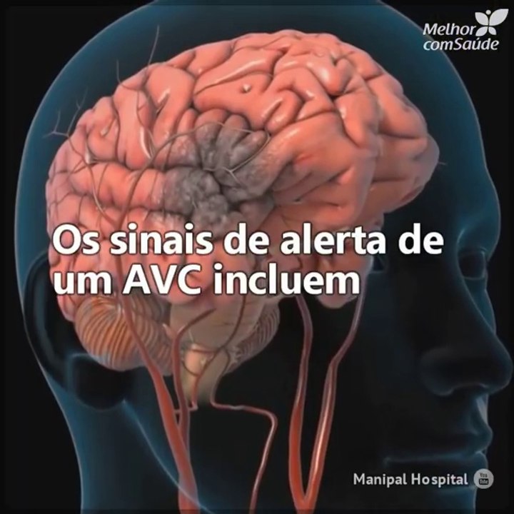 Como detectar um AVC a tempo e salvar a sua vida?