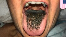 Here's why you could have 'black 'hair on your tongue