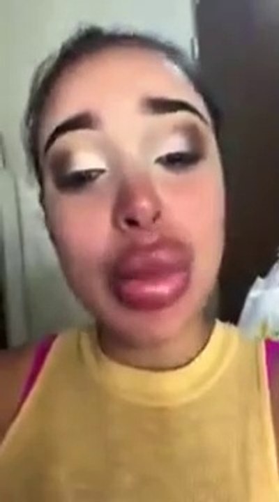Cette fille craque parce que sa chirurgie des lèvres a été loupée.