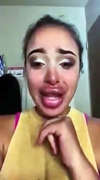 Une fille déprimée par sa chirurgie esthétique des lèvres terrible !