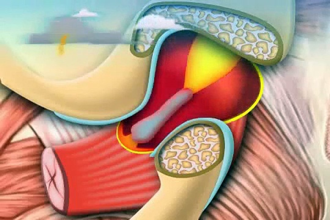 wenn plötzlich Zähne nicht aufeinander passen - Kiefergelenkserguss