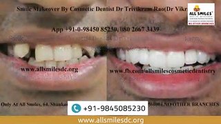 Smile Makeover Before and After | Cosmetic Dentistry in Bangalore, India