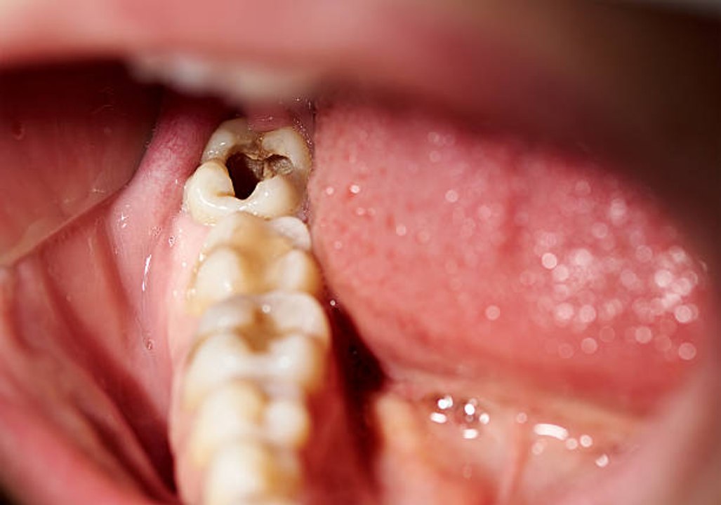 Comment éviter les caries ?