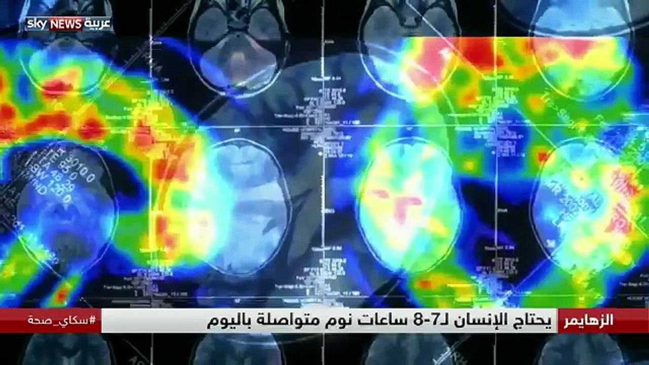 دراسة: قلة النوم قد تزيد من مخاطر الإصابة بألزهايمر