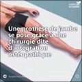 Voici comment se réalise la pose d'une prothèse de jambe