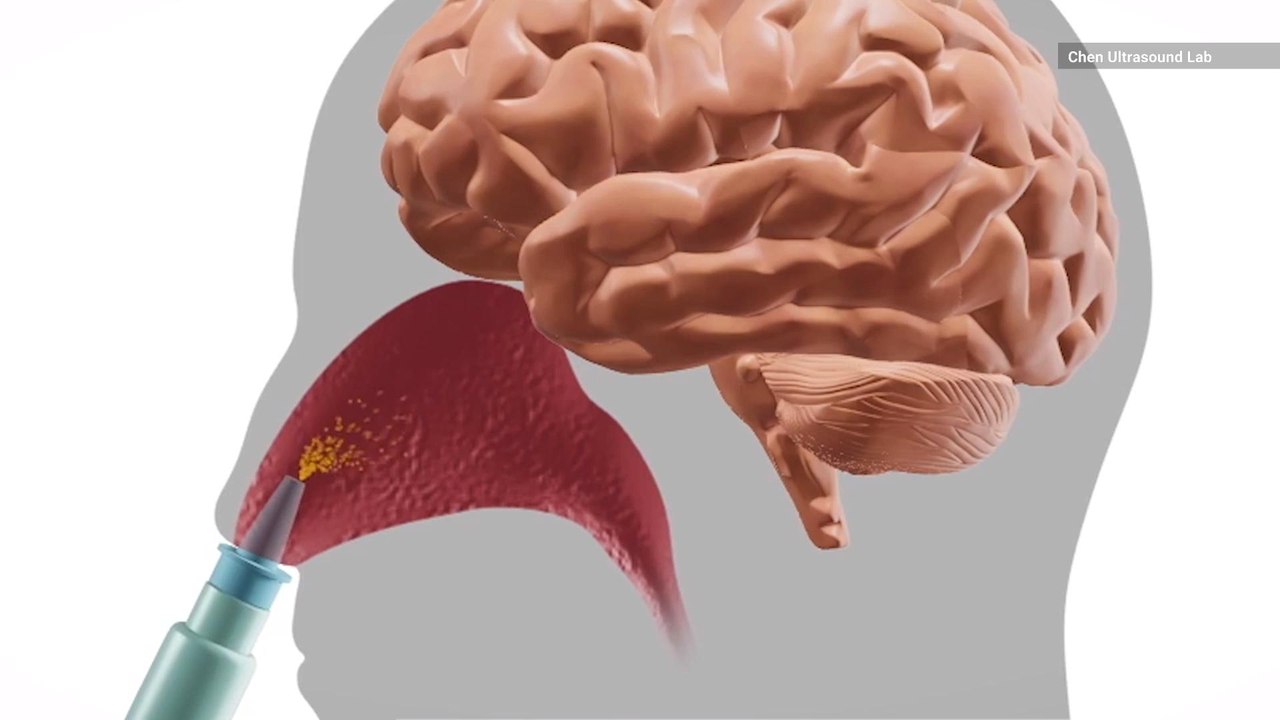 Scientists Are Testing Nasal Spray To Treat Bra...